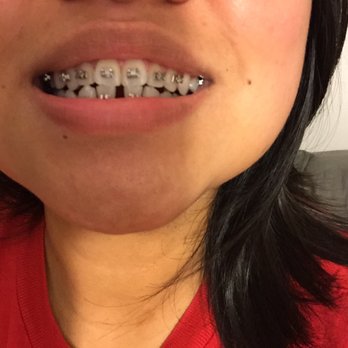 Dung Orthodontics - Before - Orthodontists Near Me - Aiea, Hawaii Dung Orthodontics - Before - Orthodontists Near Me - Aiea, Hawaii