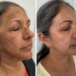 Honeys Skincare - Before / After
