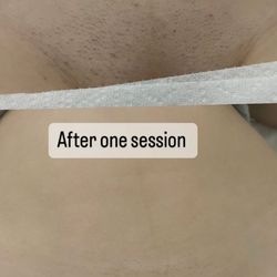 Le Belle Skin Laser