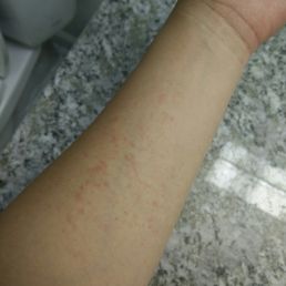 Itchy red bumps all over my body after my massage Itchy red bumps all over my body after my massage