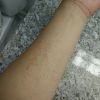 Northern Thai Massage - Itchy red bumps all over my body after my massage - Massage Near Me - Clovis, California Northern Thai Massage - Itchy red bumps all over my body after my massage - Massage Near Me - Clovis, California