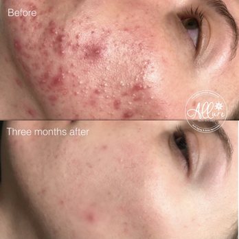 Allure Skin Studio - Acne Program. - Skin Care Near Me - Lemont, Illinois