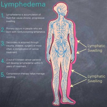 Restorative Massage Therapy - What is Lymphedema? - Massage Therapy Near Me - Barrie, Ontario Restorative Massage Therapy - What is Lymphedema? - Massage Therapy Near Me - Barrie, Ontario