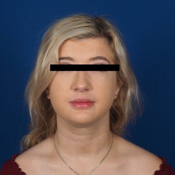 Potomac Plastic Surgery: Houtan Chaboki, MD - Picture taken in office right before procedure. I had no jowls, skin issues, or dark circles. - Medical Spas Near Me - Washington Dc, District of Columbia