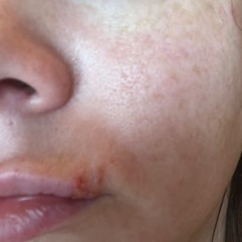Farrah Beauty Center - Burns from the extraction tool. - Medical Spas Near Me - Sterling, Virginia
