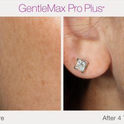 Reborn Laser Clinic - Subtle changes, powerful results. Pigment correction with GentleMax Pro Plus at Reborn Laser Clinic.
