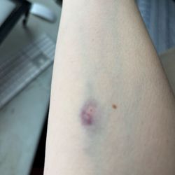 Restore Hyper Wellness - Bruising after my IV