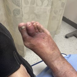 Robert P. Dunne, DPM - Swollen toe that Dunne said was 'just swollen' 2 days prior