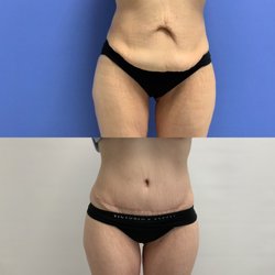 Bruggeman Plastic Surgery & Aesthetics - This patient lost a significant amount of weight and had a tummy tuck to repair her abdominal wall and tighten her skin.