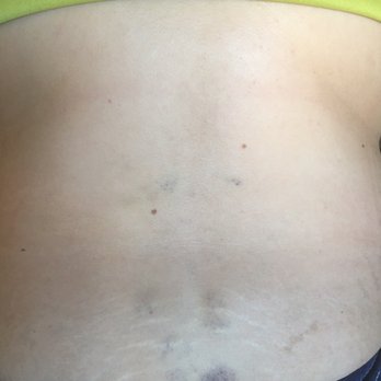 Star Massage - The bruises that were left on my back from my massage yesterday 2/22/17 - Beauty & Spas Near Me - Chula Vista, California Star Massage - The bruises that were left on my back from my massage yesterday 2/22/17 - Beauty & Spas Near Me - Chula Vista, California