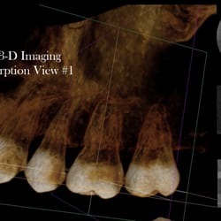 Glendale Endodontics & Microsurgery - David Abdelmalak,DDS - First view of a Cone Beam 3-D image of Internal Root Resorption