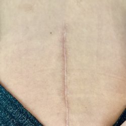 My incision after seven months. I couldn't be more pleased.