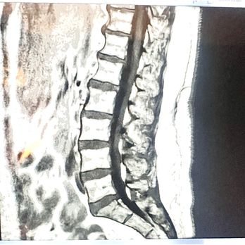 Axis Spine Center - multiple disc protrusions, extrusions and fractures in the vertebrae. T11/12 flattening of Conus - Spine Surgeons Near Me - Coeur d'Alene, Idaho Axis Spine Center - multiple disc protrusions, extrusions and fractures in the vertebrae. T11/12 flattening of Conus - Spine Surgeons Near Me - Coeur d'Alene, Idaho