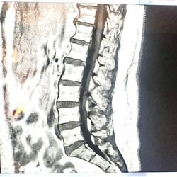 Axis Spine Center - multiple disc protrusions, extrusions and fractures in the vertebrae. T11/12 flattening of Conus