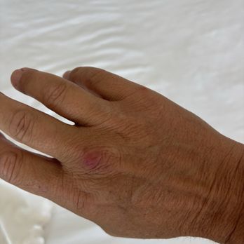 Classen Inn - Bedbug bite - Hotels Near Me - Oklahoma City, Oklahoma