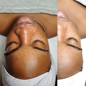 Skin Identity - Before & After ::. Signature Detox with Dermaplane Facial - Skin Care Near Me - Washington, DC, District of Columbia Skin Identity - Before & After ::. Signature Detox with Dermaplane Facial - Skin Care Near Me - Washington, DC, District of Columbia