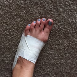 Morse Upshaw - Advanced Foot Care Center - Fred Flintstone foot!