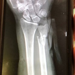 Eric L. Giang, D.O - Repaired fractured ulna with partial bone loss .