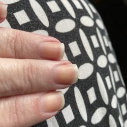 Orange stained nails, after taking off revalue polish 7 days later.