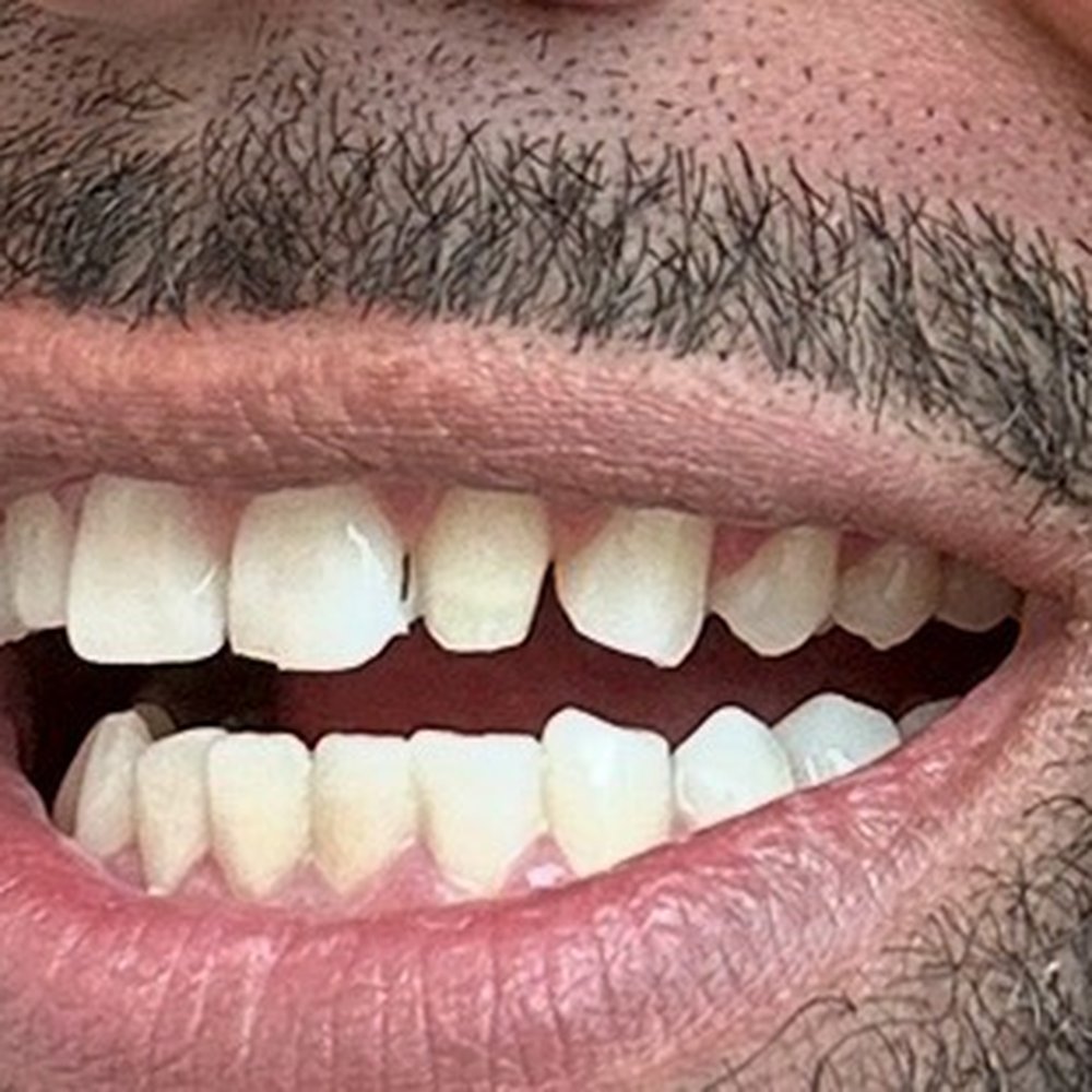 Smile Texas - my temps breaking - Cosmetic Dentists Near Me - Sugar Land, Texas