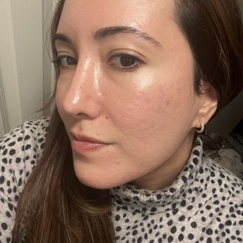 OC Surgical - One month post Acne laser and Genesis laser treatment Loving the results!! No makeup! - Laser Eye Surgery/Lasik Near Me - Santa Ana, California
