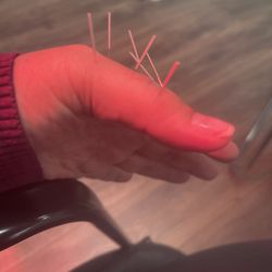 The Wellness Studio - Trigger thumb and carpal tunnel treatment.