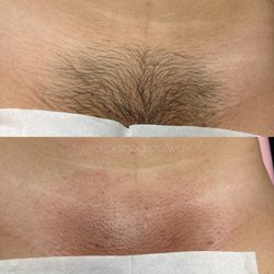 Alex’s House of Wax - Brazilian Before & After