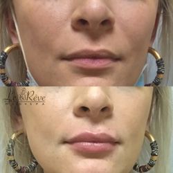 Le Reve Med Spa - Natural Lip filler by Dr. Zaki