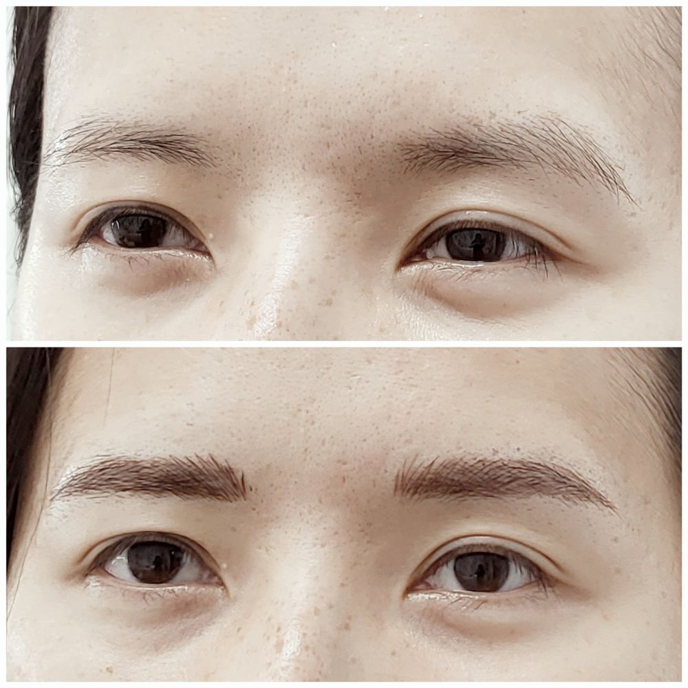 Immediate before and after