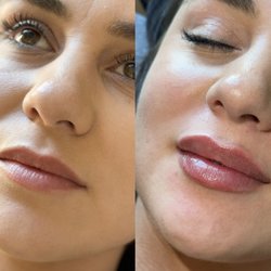 Katie Estes - Lip filler before & after using Restylane Kysse