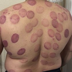 Remedy Thai Massage - Cupping therapy