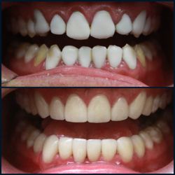 Sycamore Dentistree  - Full mouth restorative work using veneers.