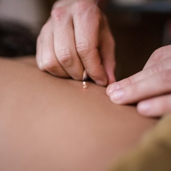 Bumblebee AcuTherapy - Direct moxa therapy - Acupuncture Near Me - Lakewood, Colorado Bumblebee AcuTherapy - Direct moxa therapy - Acupuncture Near Me - Lakewood, Colorado