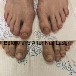 Michael R. Cook, Podiatry - Before and after nail laser treatments