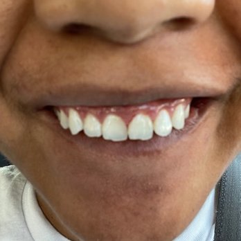 Astra Dental - BEFORE (front teeth are fractured on the bottom) - General Dentistry Near Me - San Leandro, California Astra Dental - BEFORE (front teeth are fractured on the bottom) - General Dentistry Near Me - San Leandro, California