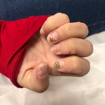 Fountain Nail Bar - Fingernail infection - Nail Salons Near Me - El Paso, Texas