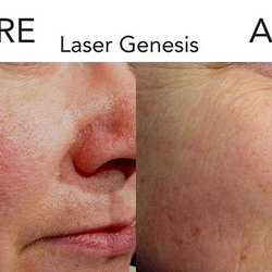 Derma Health Skin & Laser - Laser Genesis is a non-invasive laser treatment that works to even skin tones, treat fine lines and wrinkles, scars, large pores and acne.