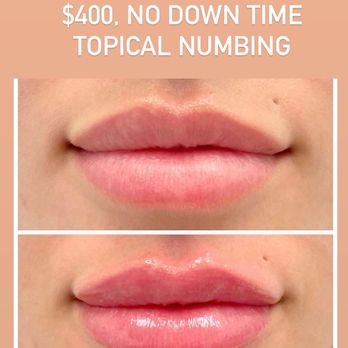 Lumi Lash - Half syringe lip filler - Eyelash Service Near Me - Lakewood, Colorado Lumi Lash - Half syringe lip filler - Eyelash Service Near Me - Lakewood, Colorado