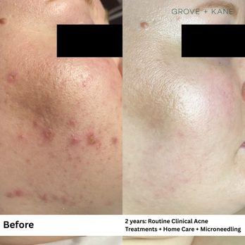 Grove and Kane - Clinical Acne + Microneedling - Skin Care Near Me - Everett, Washington Grove and Kane - Clinical Acne + Microneedling - Skin Care Near Me - Everett, Washington