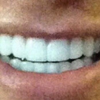 Elena Benjamin, DDS - Pearly whites after my visit today with Dr.B - Cosmetic Dentists Near Me - West Hollywood, California