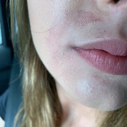 These are the markings on her face left from one waxing session. Praying it doesn't scar . These are the markings on her face left from one waxing session. Praying it doesn't scar .