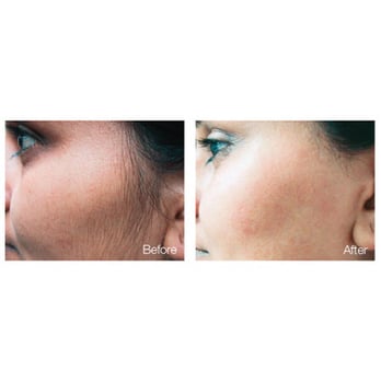 Matrix Electrolysis - Hair Removal Near Me - Burnaby, British Columbia Matrix Electrolysis - Hair Removal Near Me - Burnaby, British Columbia