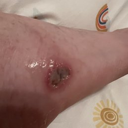 A close up of the infected foot and it was swollen.