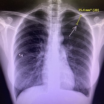 Shisong Guo - Acupuncturist - Dr Guo's unprofessional and careless behavior caused me the pneumothorax!!! - Acupuncture Near Me - San Francisco, California Shisong Guo - Acupuncturist - Dr Guo's unprofessional and careless behavior caused me the pneumothorax!!! - Acupuncture Near Me - San Francisco, California