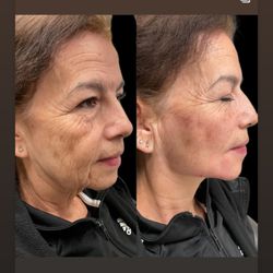 Sahar Allure Med Spa - Jaw line