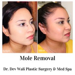 Dev Wali, MD Plastic Surgery-Medspa - Mole Removal by Dr. Wali