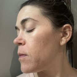 Skin Solution SF Acne Clinic - After