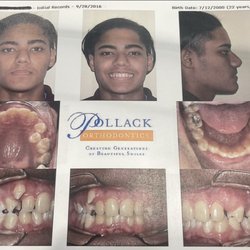 Pollack Orthodontics - Invisilign retainers treatment.