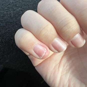 TB Nail Spa - Pinky nail swollen and broken after nail soak off - Nail Salons Near Me - Fresno, California TB Nail Spa - Pinky nail swollen and broken after nail soak off - Nail Salons Near Me - Fresno, California