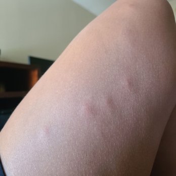Comfort Inn & Suites - Over 50 bites all over my body - Hotels Near Me - Mount Pocono, Pennsylvania